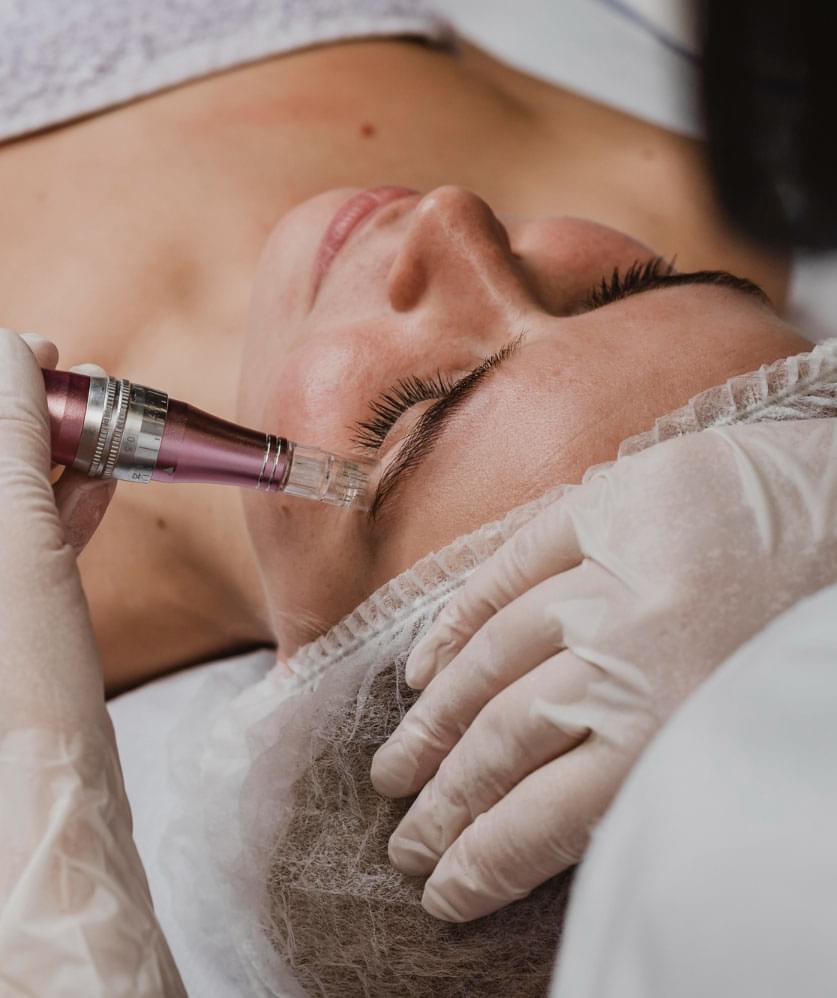 Chica realizándose una sesión de Dermapen