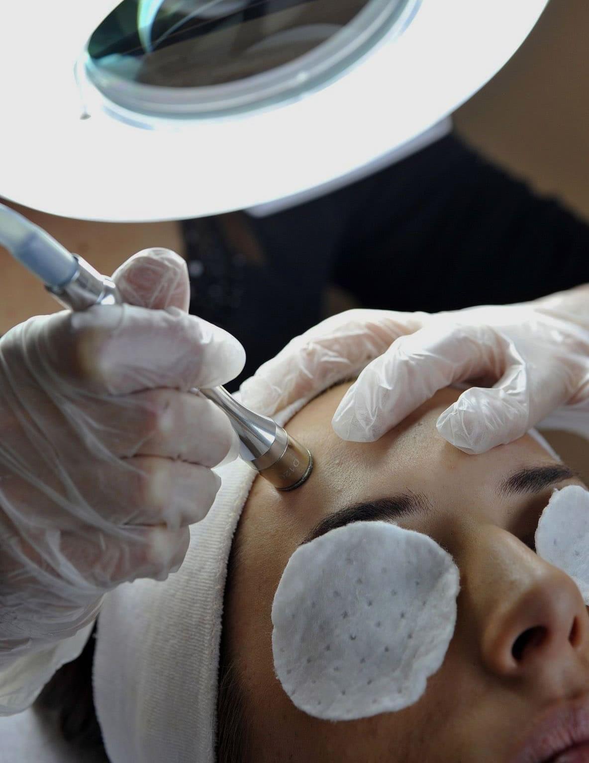 Recibiendo tratamiento facial Microneedling con Punta de Diamante